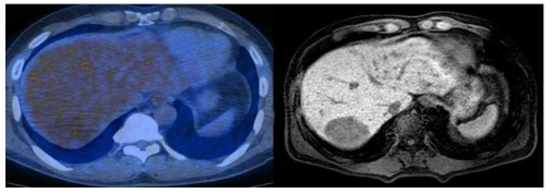 간세포암에서 낮은 tumor glycolysis (SUVmax=3.4, TNR=1.5)의 imaging phenotype을 보여주는 환자, 왼쪽 FDG PET/CT영상, 오른쪽 MRI영상