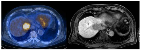 간세포암에서 높은 tumor glycolysis (SUVmax=8.4, TNR=4)의 imaging phenotype을 보여주는 환자, 왼쪽 FDG PET/CT영상, 오른쪽 MRI영상