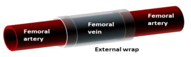 Vein to artery graft 부위를 형상기억 고분자를 이용하여 포장한 모식도