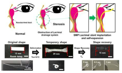 형상기억 고분자를 이용한 누관 그래프트의 개발 및 형상기억능 확인