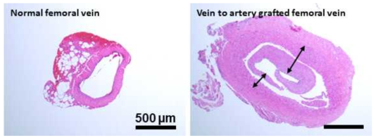 Vein to artery graft 수술 4주 후 신생내막증 발생