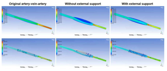 혈관 포장술 시행 후 정맥의 과팽창 방지에 따른 혈류 와류 생성 억제 시뮬레이션