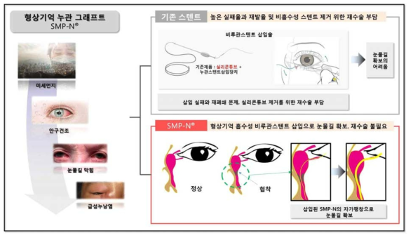 형상기억 누관 그래프트 개발 모식도