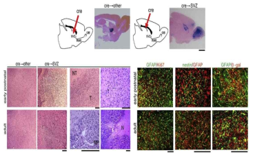 종양 억제 유전자들(p53, PTEN, NF1)이 돌연변이 된 knock-out 쥐 (cre→SVZ)에서는 종양 세포들의 침투를 관찰할 수 있으나 대조군 쥐 (cre→other)에서는 종양 세포들이 발견되지 않음 (Alcantara Llaguno et al. 2009, Cancer Cell)