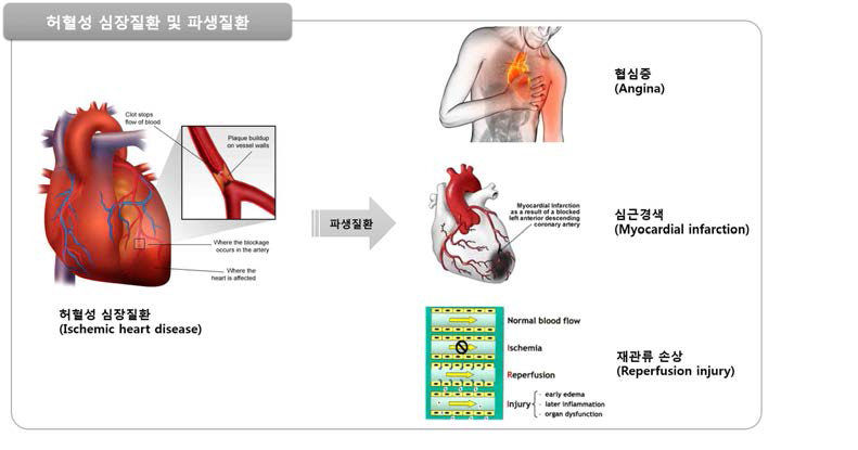 허혈성 심장질환 및 파생질환 종류