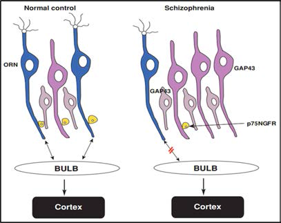 조현병의 olfactory neuroepithelium 내의 immature neuron의 증가