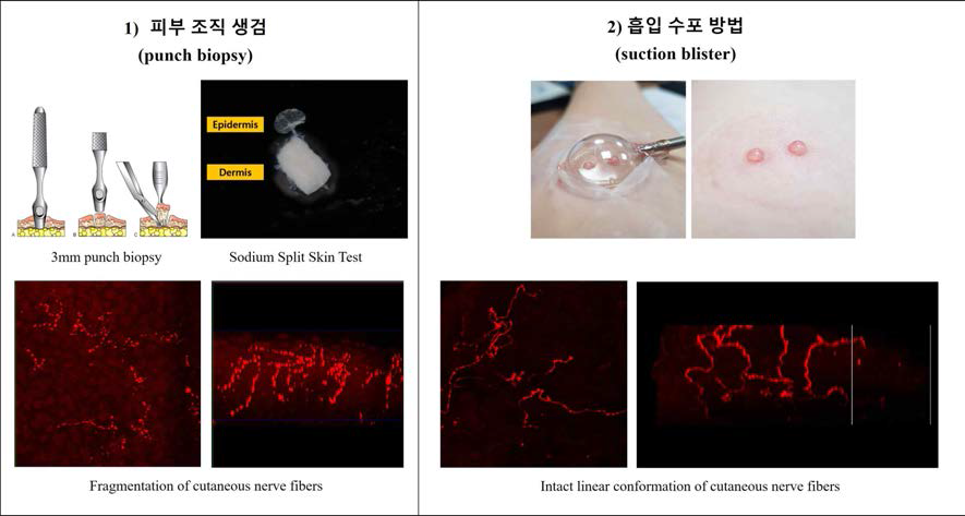 기존의 피부조직생검 방법과 대비되는 흡입 수포 방법(suction blister method)을 이용한 피부조직 획득 및 말초신경의 3차원 영상 비교