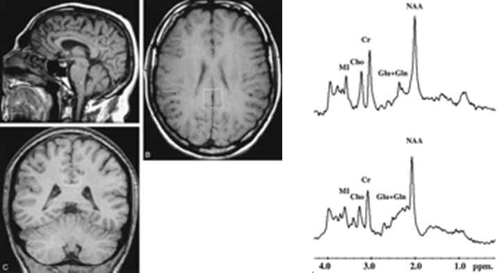 치매 환자 뇌영상과 myoinositol/creatine 분석