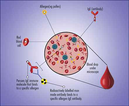 알레르기 비염환자의 혈액을 통해총 Ig E, 특이 Ig E, 혈액내 호산구 등을 통해 진단할 수 있음