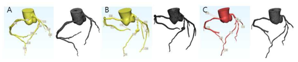 환자별 관상동맥의 해부학적 크기 및 메쉬. Participant ID: (A) #46788591, (B) #21051865, (C) #42024574