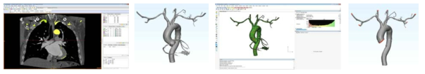 제작된 3D 경동맥 구조 스무딩 작업 및 메쉬 확인 및 경계 설정