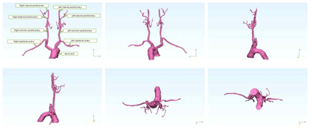 해부학적 구조를 고려하여 제작한 3D 혈류영역 경동맥 모델