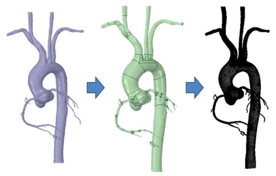 혈관 형상 모델링 전처리 과정. 해부학적 구조를 생성하여 혈관 표면을 재생성하여 격자를 생성함