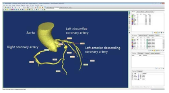 3D 해부학적 구조에서의 관상동맥의 부위별 길이와 직경 측정