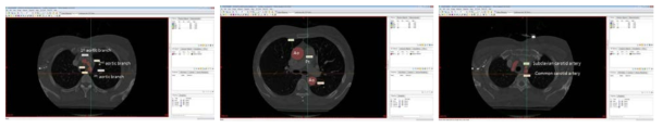 CT상에서 대동맥의 부위별 길이와 직경 측정