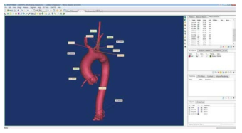 3D 해부학적 구조에서의 대동맥의 부위별 길이와 직경 측정