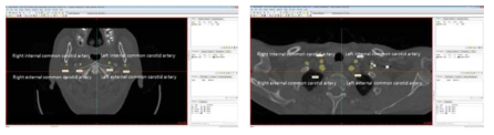 CT상에서 경동맥의 두께와 지름 측정