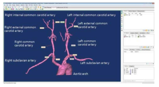 3D 해부학적 구조에서의 경동맥의 부위별 길이와 직경 측정