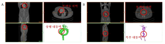 대동맥 부위에 따른 병변 및 취약지점 확인. (A) 상행 대동맥에서의 동맥류 CT 이미지 및 3D 구조, (B) 복부 대동맥에서의 동맥류 CT 이미지 및 3D 구조