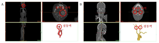 내외경동맥 병변 및 취약지점 확인. (A) 경동맥 동맥류 CT 이미지 및 3D 구조, (B) 동맥경화성 경동맥 CT 이미지 및 3D 구조