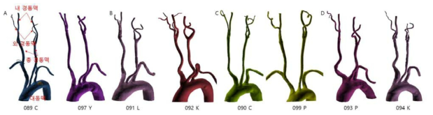 내외경동맥의 각도, 비틀어짐, 꼬임 등에 따른 형태학적 분류. (A) 스트레이트, (B) 비틀림, (C) 코일링 D) 킹킹