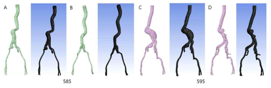 복부 대동맥류 환자 모델의 기하학적 구조 및 메쉬. 혈류 역학 분석을 위해 복부 대동맥 및 대퇴 동맥에 대한 기하학적 구조를 생성하였으며 그 구조를 이용하여 메쉬 생성