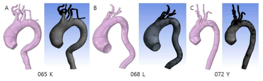 상행 대동맥류 환자 모델의 기하학적 구조 및 메쉬. 혈류 역학 분석을 위해 상행 대동맥 및 분지에 대한 기하학적 구조를 생성하였으며 그 구조를 이용하여 메쉬 생성