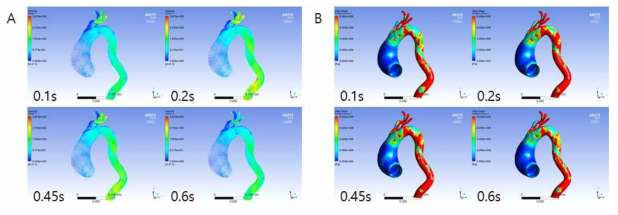 상행 대동맥류 환자모델에서 심장주기에 따른 속도 및 벽 전단응력 분포 분석. (A) 심장주기에 따른 속도 분포, (B) 심장주기에 따른 벽 전단응력 분포