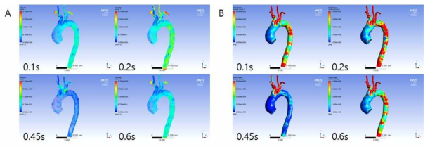 상행 대동맥류 환자모델에서 심장주기에 따른 속도 및 벽 전단응력 분포 분석. (A) 심장주기에 따른 속도 분포, (B) 심장주기에 따른 벽 전단응력 분포
