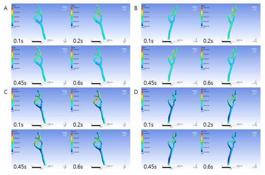 092 K 환자의 좌, 우 경동맥에서의 심장주기에 따른 속도 및 벽 전단응력 분포 분석. (A) 좌경동맥 속도, (B) 우경동맥 속도, (C) 좌경동맥 벽 전단응력, (D) 우경동맥 벽 전단응력