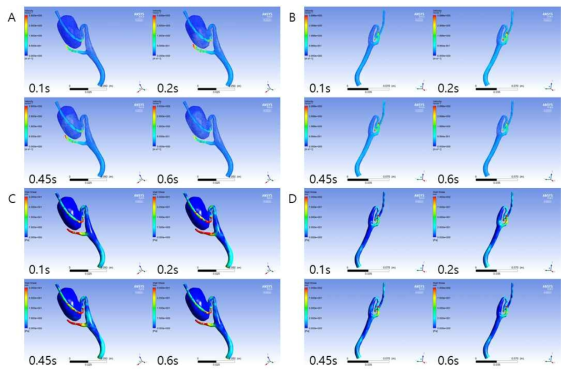 080 W 환자의 좌,우경동맥에서의 심장주기에 따른 속도 및 벽 전단응력 분포 분석. (A) 좌경동맥 속도, (B) 우경동맥 속도, (C) 좌경동맥 벽 전단응력, (D) 우경동맥 벽 전단응력
