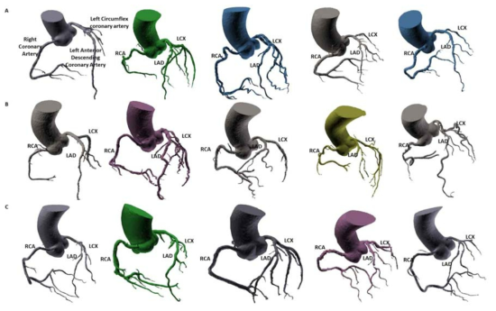 관상동맥의 형태에 따라 분류. Left anterior descending coronary artery (LAD), Left circumflex coronary artery (LCX)와 Right coronary artery (RCA)의 우세에 따른 분류 작업 진행함. (A) 균등우세, (B) 좌우세, (C) 우우세 구조에서 관상동맥의 부위별 길이와 직경 측정
