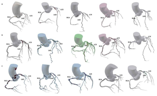 각 관상동맥에서의 위치와 정도에 따른 경화반 모델. (A) 경화반이 주로 LCX와 LAD에 존재하며 협착 정도는 mild stenosis (0-39%), (B) 경화반이 전반적으로 양쪽 관상동맥에 존재하며 협착 정도는 moderate stenosis (40-69%), (C) 경화반이 전반적으로 양쪽 관상동맥에 존재하며 협착 정도는 severe stenosis (70-99%)