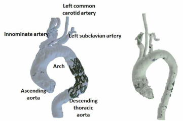 대동맥에서의 스텐트와 경화반 모델. 대동맥 환자의 경우 arch와 descending thoracic aorta 사이에 동맥류가 많이 발생했음. 협착은 ascending aorta에 발생하는 것을 확인함