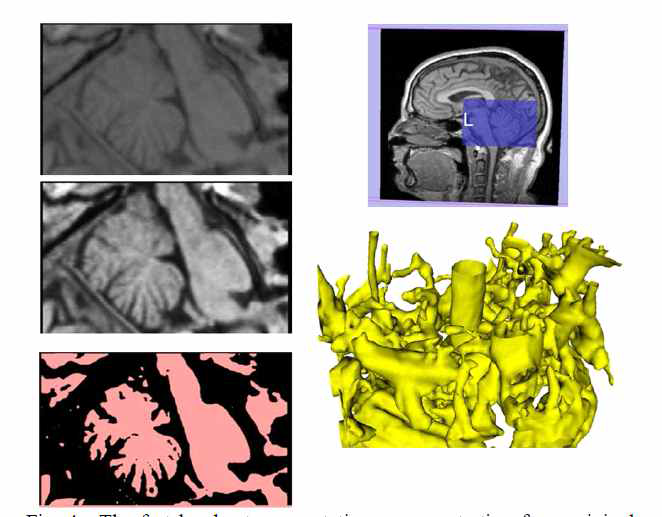 MRI 영상 모듈 3D 혈관 추출 알고리즘