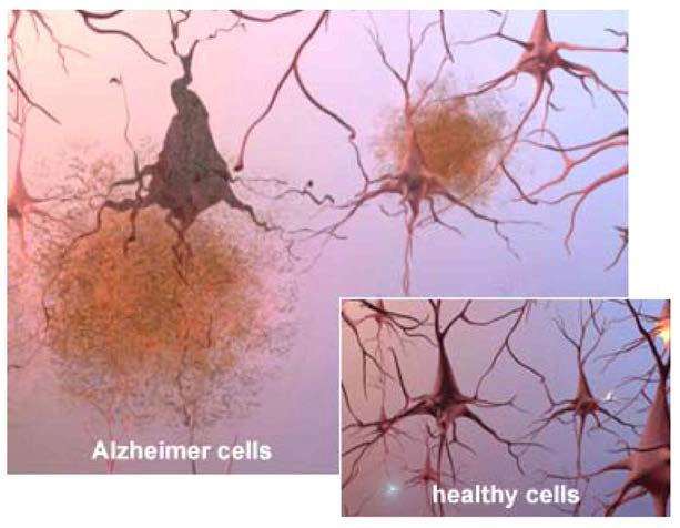 알쯔하이머 병 환자의 뇌 조직에서 발견되는 병리학적 소견. 건강한 사람에 비해 신경세포 및 시냅스들이 거의 존재하지 않음