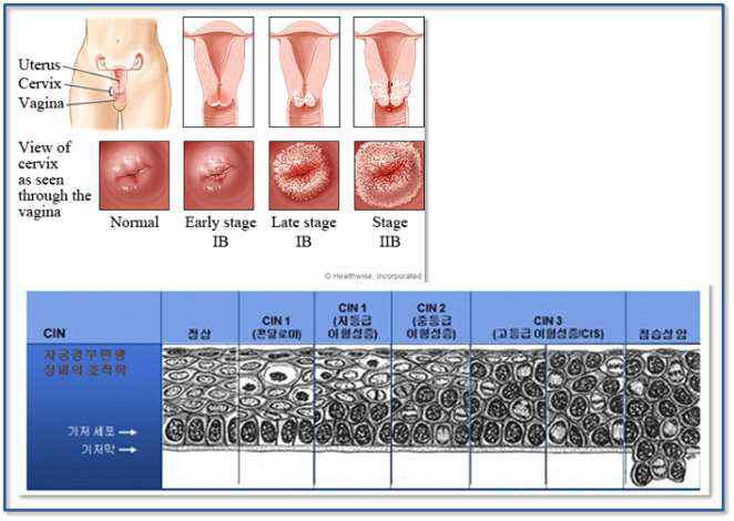 자궁경부암 발병 진행 단계