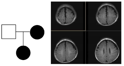 MCD 신규유전자 동정 가계 및 MRI 이미지