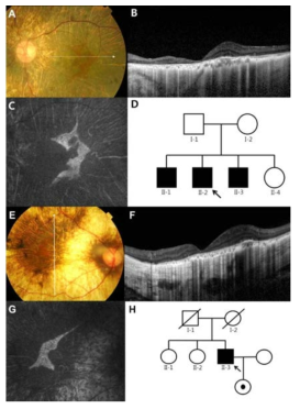 Ocular phenotypes shown in the probands and the pedigrees of family A (A-D) and family B (E-H). (A,E) Fundus photograph. (B,F) Spectral-domain optical coherence tomography. (C,G) Fundus autofluorescence photograph. (D,H) Pedigrees of the two families
