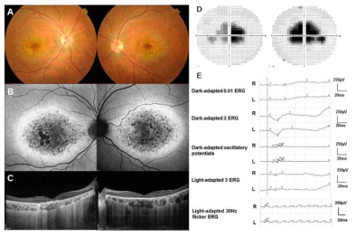 Fundus photographs (A), fundus autofluorescence photographs (B), Spectral-domain optical coherence tomography (C), automated visual field (D), and full-field electroretinogram (E) of the affected proband with Stargardt-like macular dystrophy 4