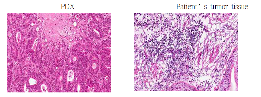 H&E staining of tumor tissue from PDX mouse and patient's tumor tissue. There is a histologic similarity between tumor cells showing glandular pattern in frozen tissue and PDX tumor.(by Pathologist review)