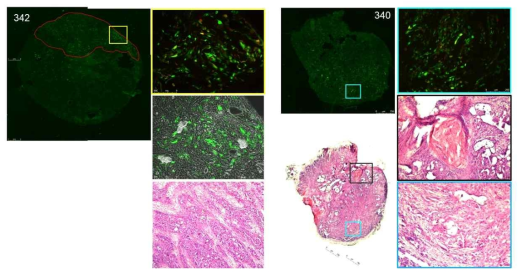 PDX-367 암 덩어리에서의 형광 단백질의 발현 및 neutrophil infiltration. 340, 342 마우스에서 적출한 암 덩어리의 형광사진 (왼쪽, 오른쪽 위), H & E staining 사진 (오른쪽, 왼쪽 아래), 그리고 bright field 이미지와 형광 이미지가 합쳐진 사진 (왼쪽 가운데). 342 암 절편의 빨간색 동그라미는 형광 단백질은 발현하는 구역을 표시하고 있음