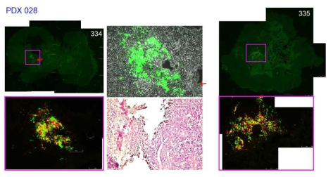 PDX-028 암 덩어리에서의 형광 단백질의 발현 및 neutrophil infiltration. 334, 335 마우스에서 적출한 암 덩어리의 형광사진 (왼쪽 오른쪽 위, 아래), H & E staining 사진 (가운데 아래), 그리고 bright field 이미지와 형광 이미지가 합쳐진 사진 (가운데 위). 빨간색 화살표는 neutriphil infiltration을 표시함