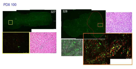 PDX-100 암 덩어리에서의 형광 단백질의 발현 및 neutrophil infiltration. 321, 323 마우스에서 적출한 암 덩어리의 형광사진 (왼쪽 오른쪽 위), H & E staining 사진 (맨 오른쪽 위 및 왼쪽 중간 아래), 그리고 bright field 이미지와 형광 이미지가 합쳐진 사진 (오른쪽 중간 아래). 328 암 절편의 빨간색 동그라미는 형광 단백질은 발현하는 구역을 표시하고 있음