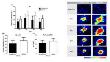 Skin blood perfusion images using laser Dopper perfusion imaging