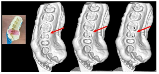 인상체에 대한 CAD 데이터. (좌) 고해상도 CT (60um), (중) 일반 치과용 CT (100um), (우) 일반 치과용 CT (140um)