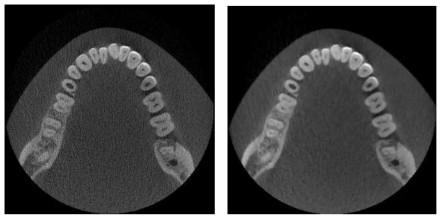Low Dose: 90kV 2mA Filter Cu0.2 (왼쪽: FBP, 오른쪽: 반복적 알고리즘)