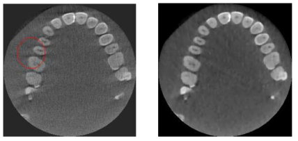 부분 투영 데이터 스캔 시의 영상 재구성 결과 (왼쪽: FBP, 오른쪽: 반복적 알고리즘)