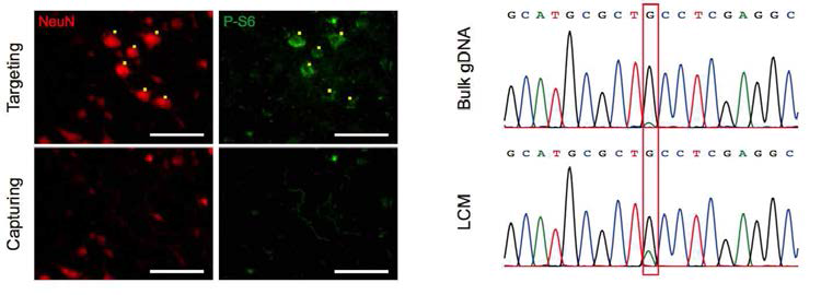 NeuN (neuronal marker), P-S6 (mTOR major readout) antibody를 이용하여 환자의 동결절편 조직에서 statining을 시행하였고 P-S6 postive cell 선택하여 laser capture 시행함