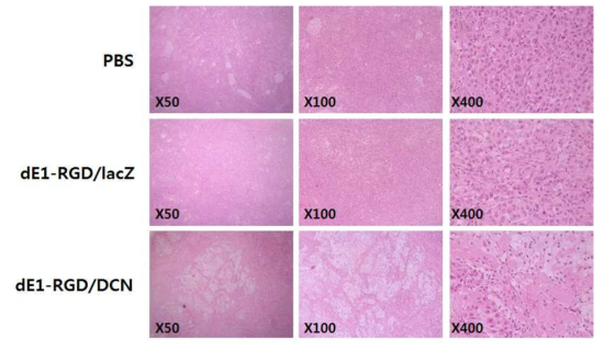DCN 유전자를 발현하는 아데노바이러스에 의한 종양조직 변화